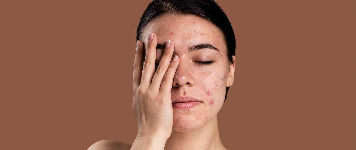 Acne and Acne Scar Treatment