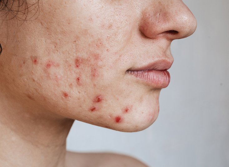 Acne Scar Treatment