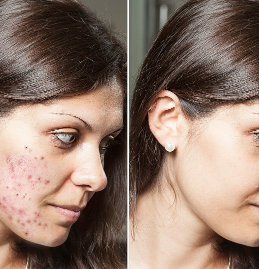 Acne Treatment