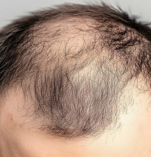 Alopecia Areata Hair Care
