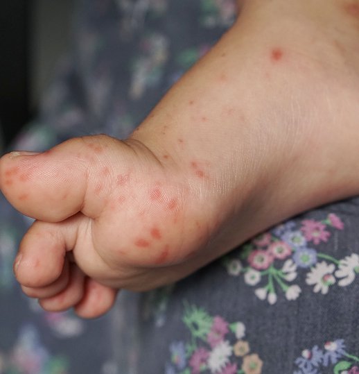 Atopic Dermatitis Treatment