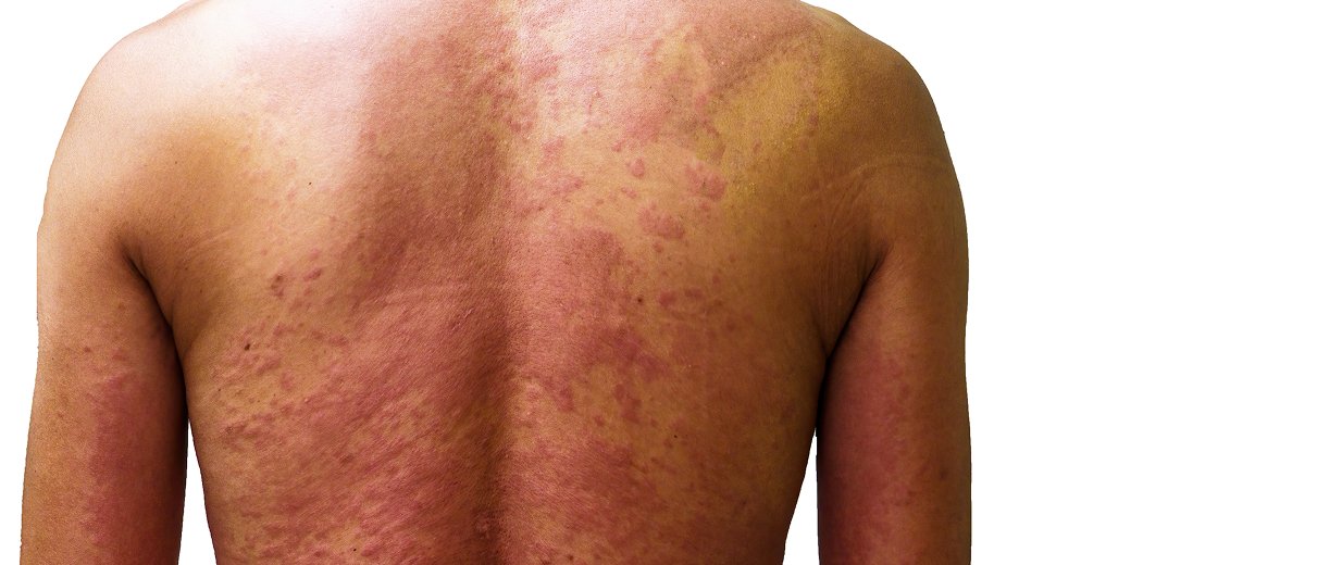 Bacterial and Viral Skin Infections Treatment
