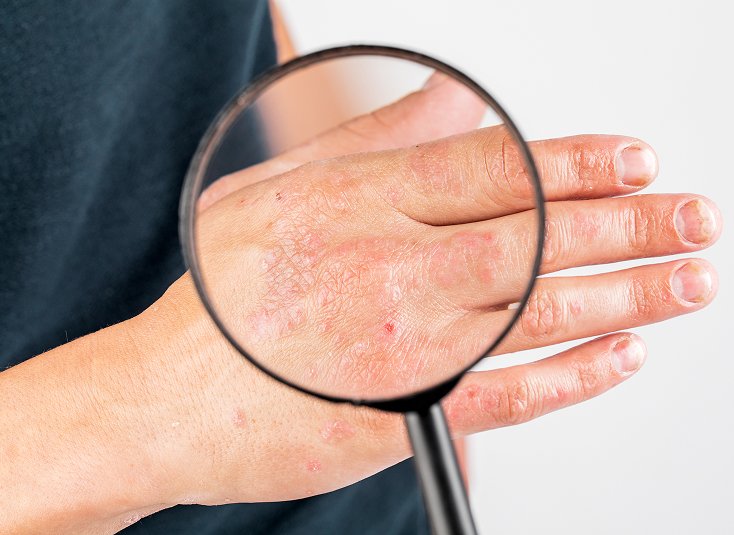 Bacterial Skin Infection Treatment