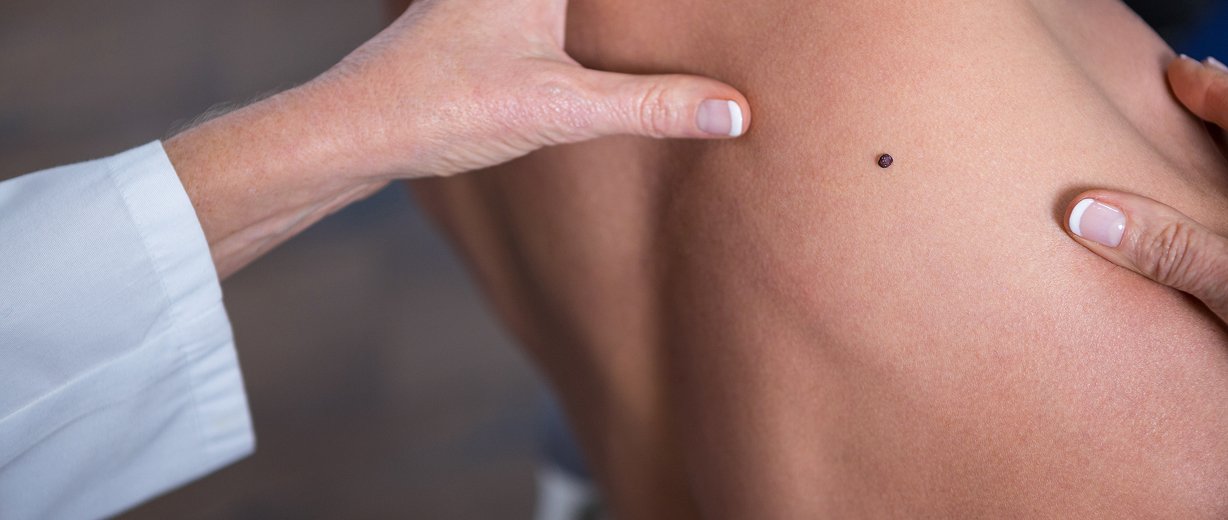 Birthmark Treatment