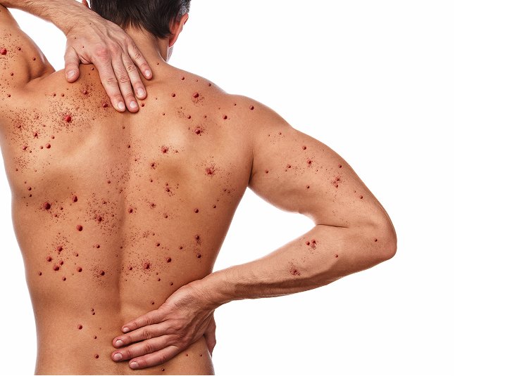 Birthmark Laser Treatment