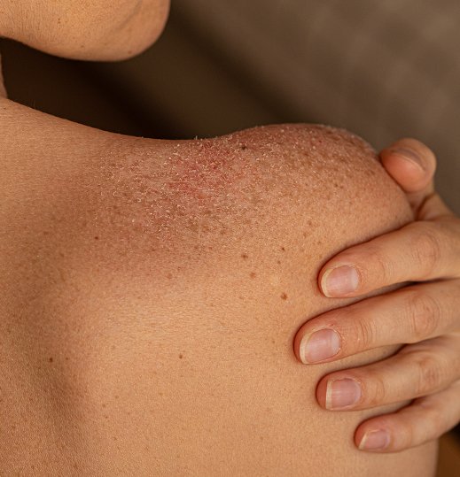 Birthmark Skin Treatment