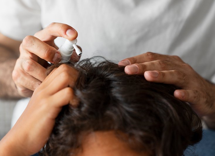 Dandruff Treatment
