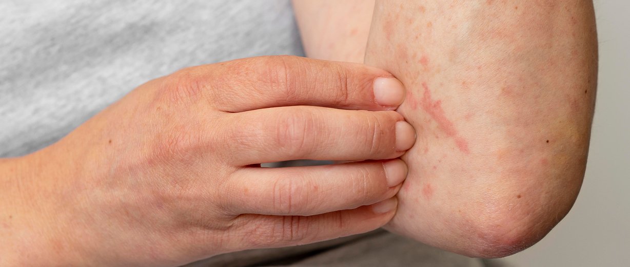 Eczema Treatment