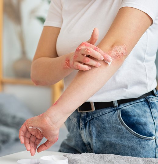 Eczema Care and Treatment