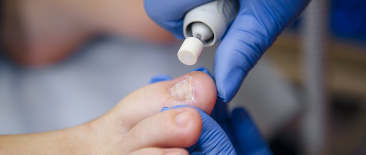 Fungal Nail Infection Treatment