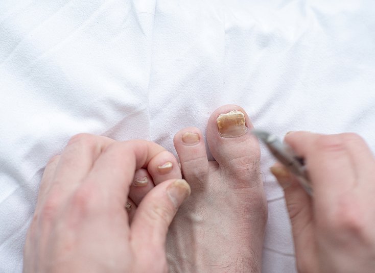 Fungal Nail Infection Care