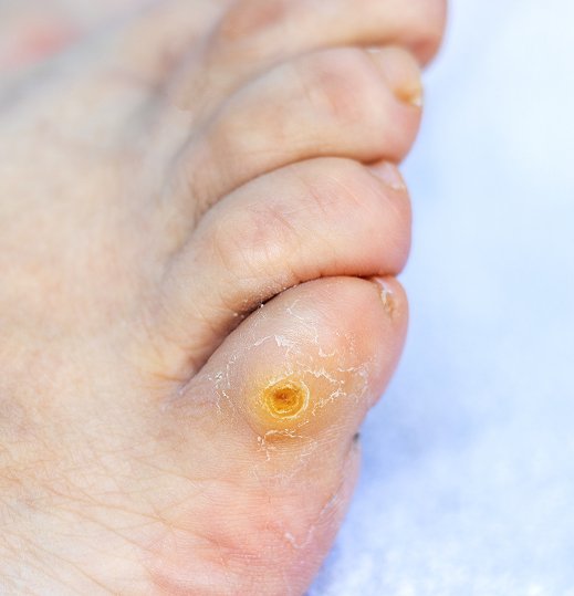 Healthy Nail Treatment