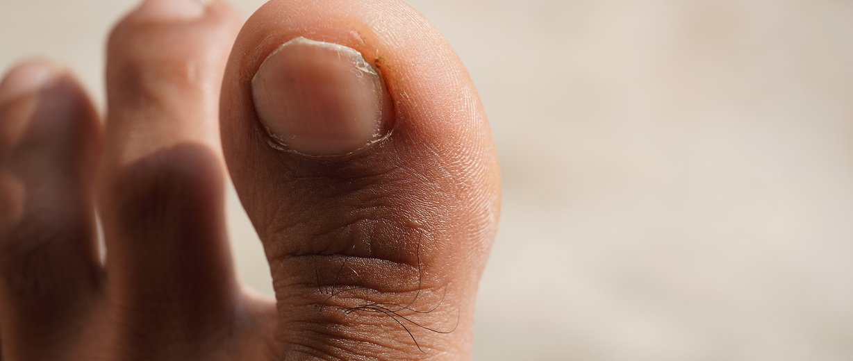 Hair and Nail Disorders in Children Treatment