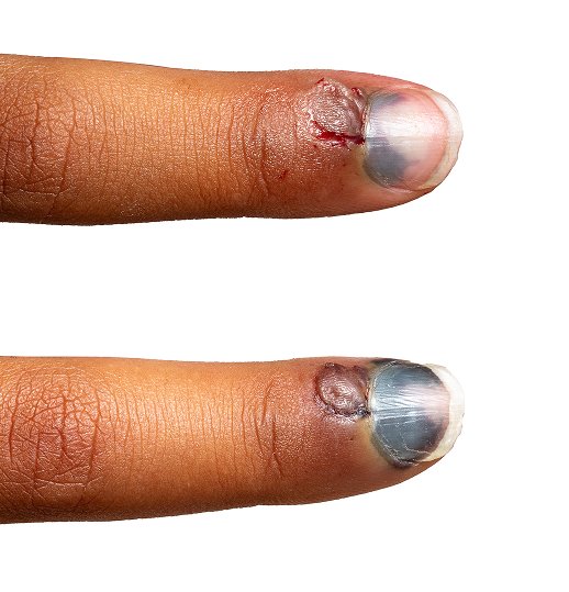 Nail Disorder Treatment in Children