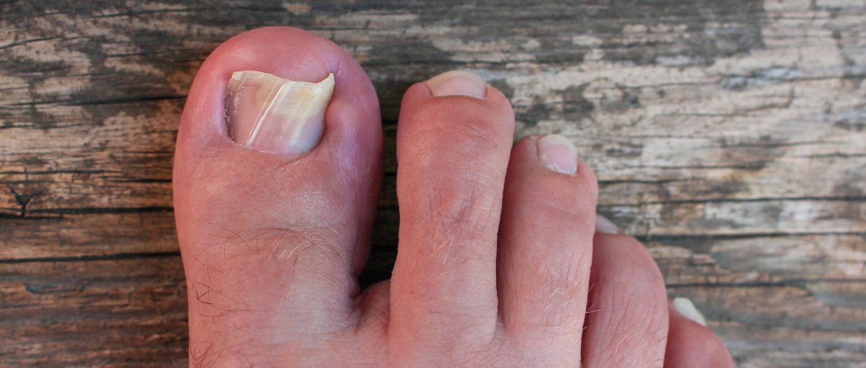 Ingrown Nail Treatment