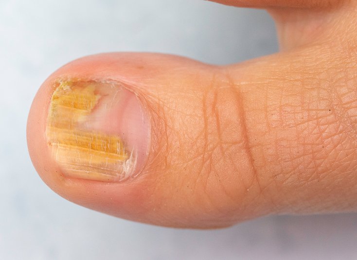 Ingrown Nail Care