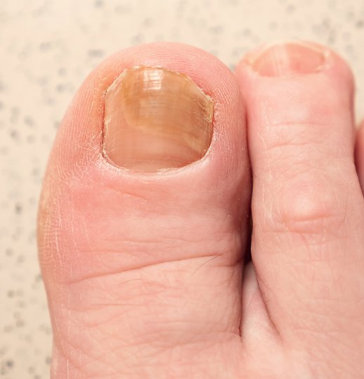 Ingrown Toenail Treatment