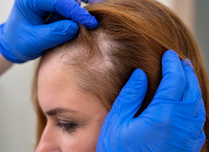 Male Pattern Hair Loss Treatment