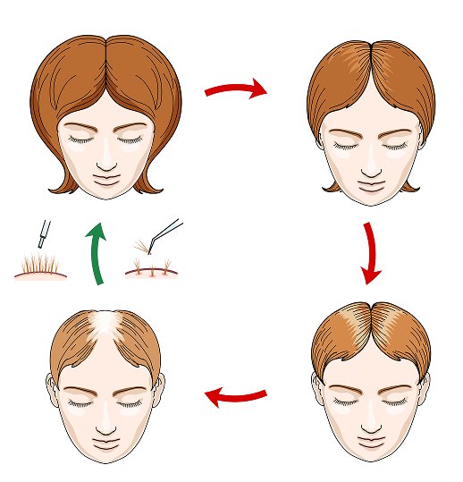 Female Pattern Hair Loss Treatment