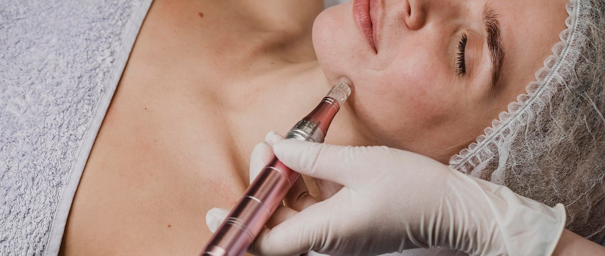 Microneedling Treatment