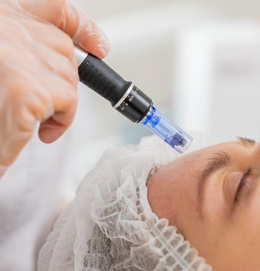 Microneedling Skin Rejuvenation