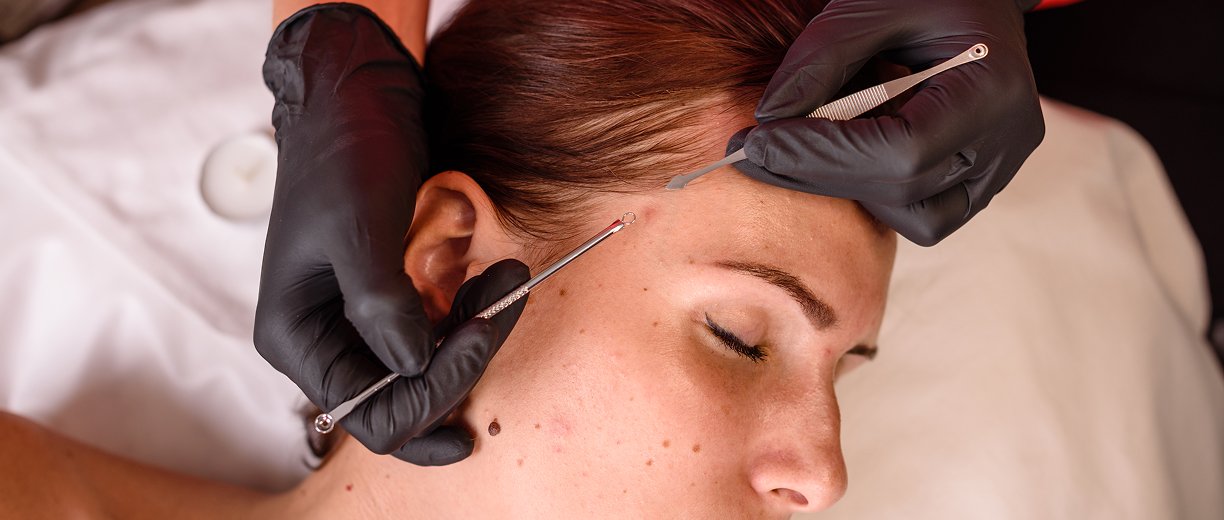 Mole Removal Treatment