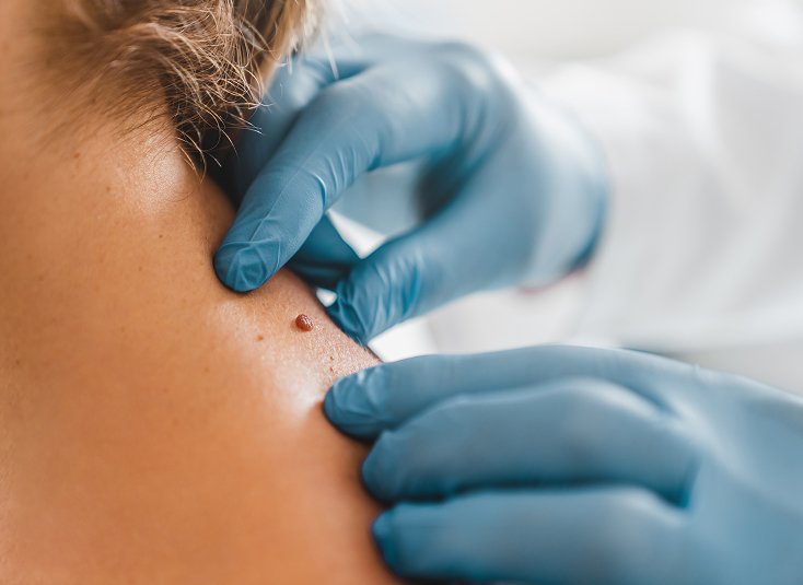 Mole Removal Procedure