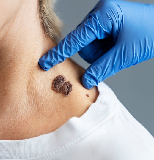 Mole Removal Treatment