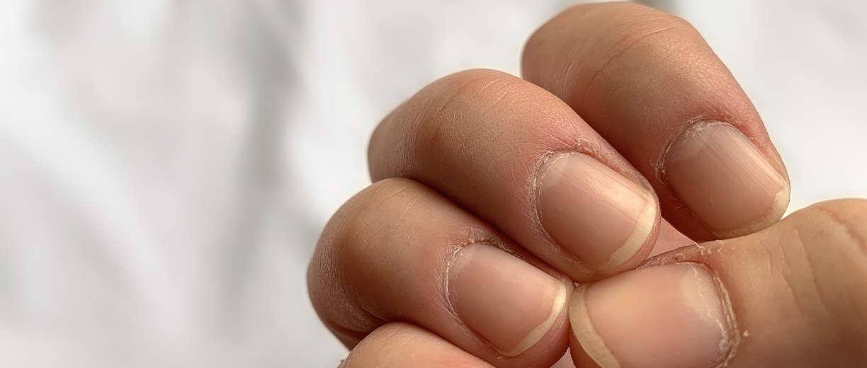 Nail Dystrophy Treatment