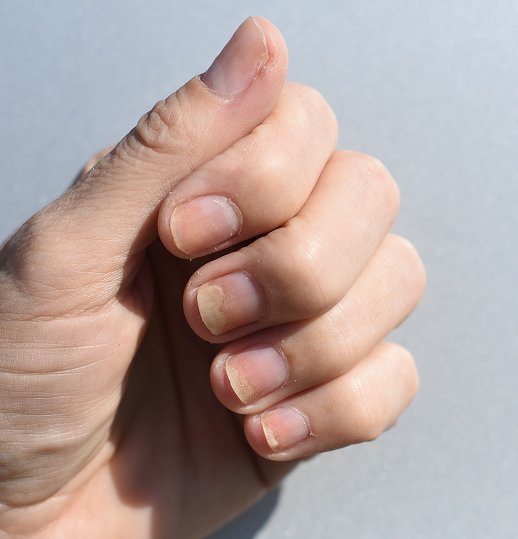 Healthy Nail Treatment