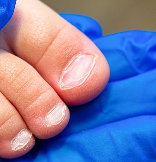 Nail Pigmentation Treatment