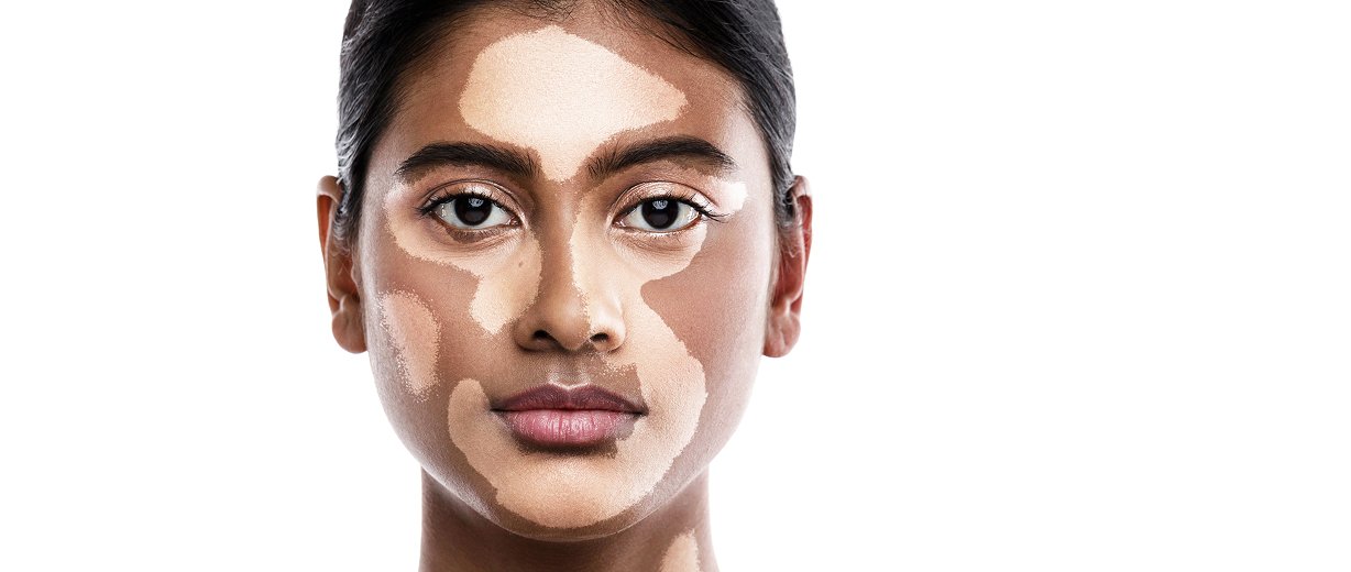 Pigmentation Disorders and Melasma Treatment