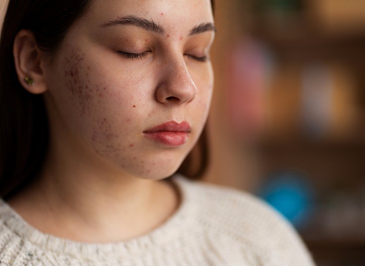 Pigmentation Treatment