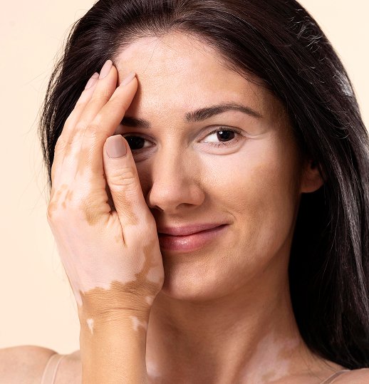 Melasma Treatment