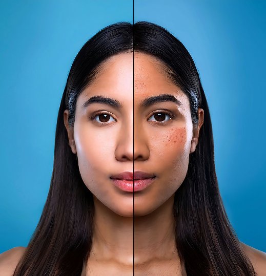 Pigmentation Laser Treatment