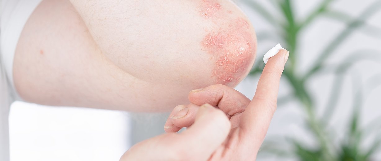 Psoriasis Treatment