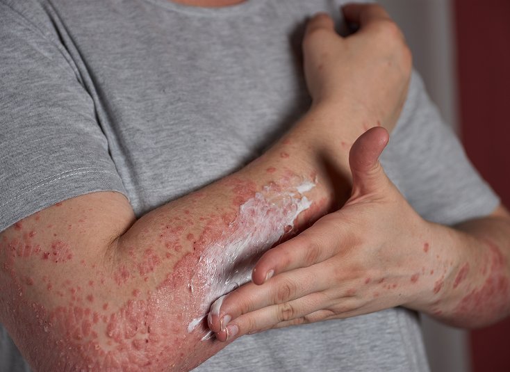 Psoriasis Skin Treatment