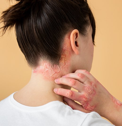 Psoriasis Care and Treatment