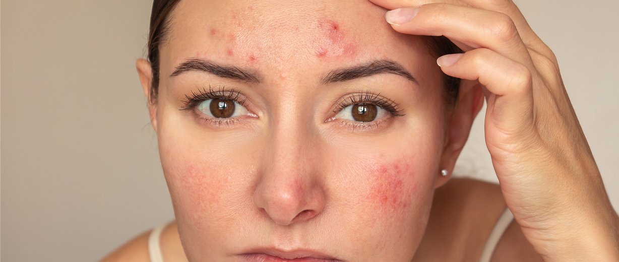 Rosacea Treatment