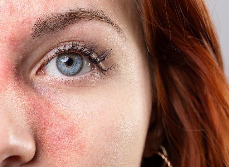 Rosacea Skin Treatment