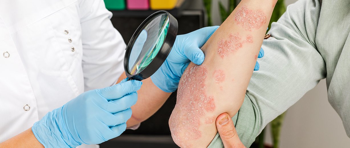 Skin Allergies Treatment
