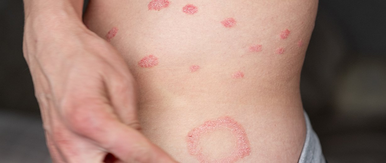 Skin Infection Treatment