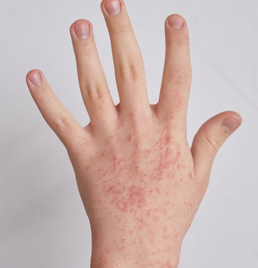 Skin Infection Care