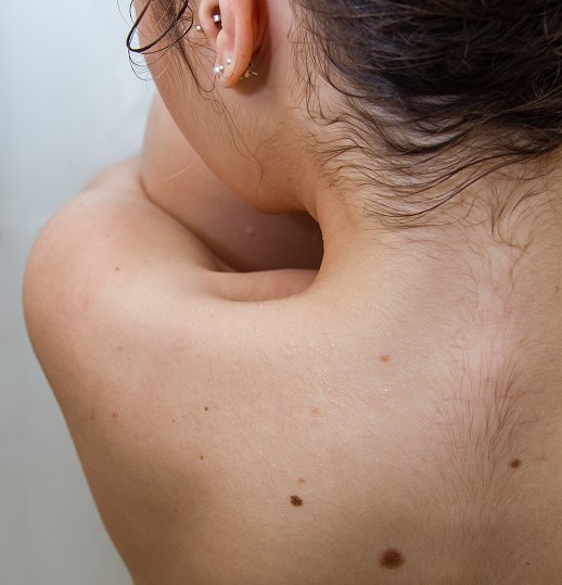 Skin Tag Treatment
