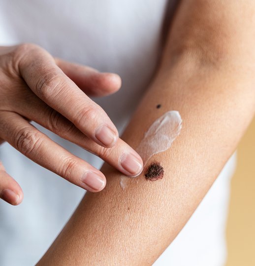 Hives Treatment and Skin Care