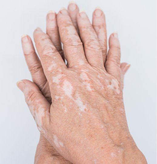 Vitiligo Skin Care