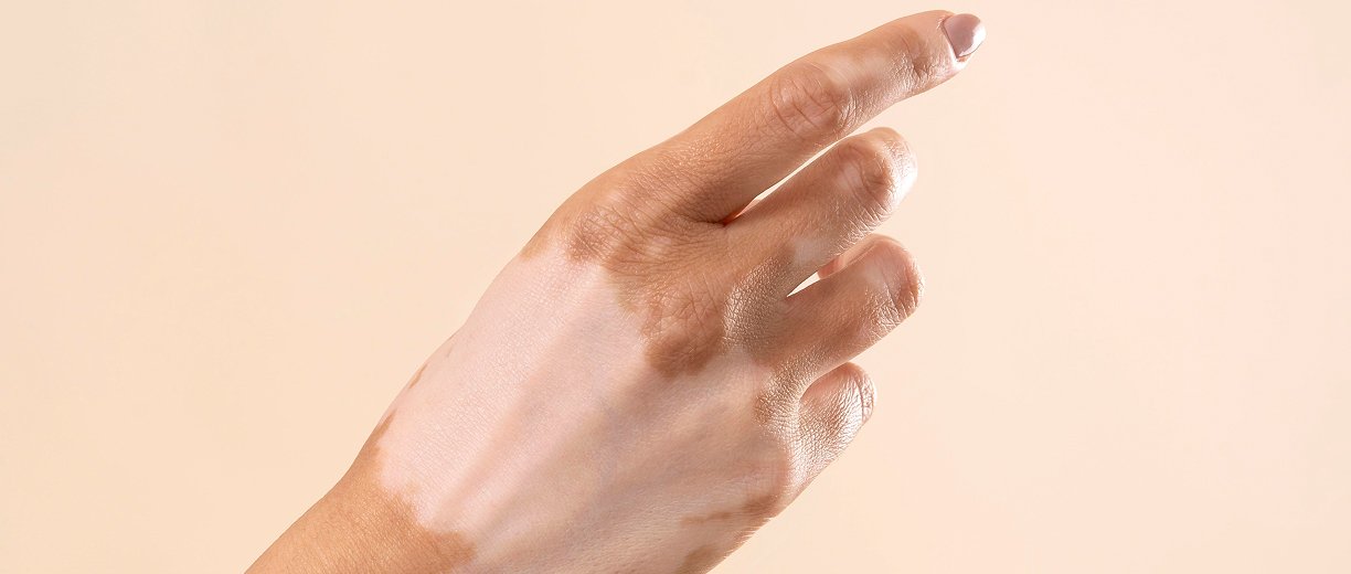 Vitiligo Surgery and Repigmentation Treatment