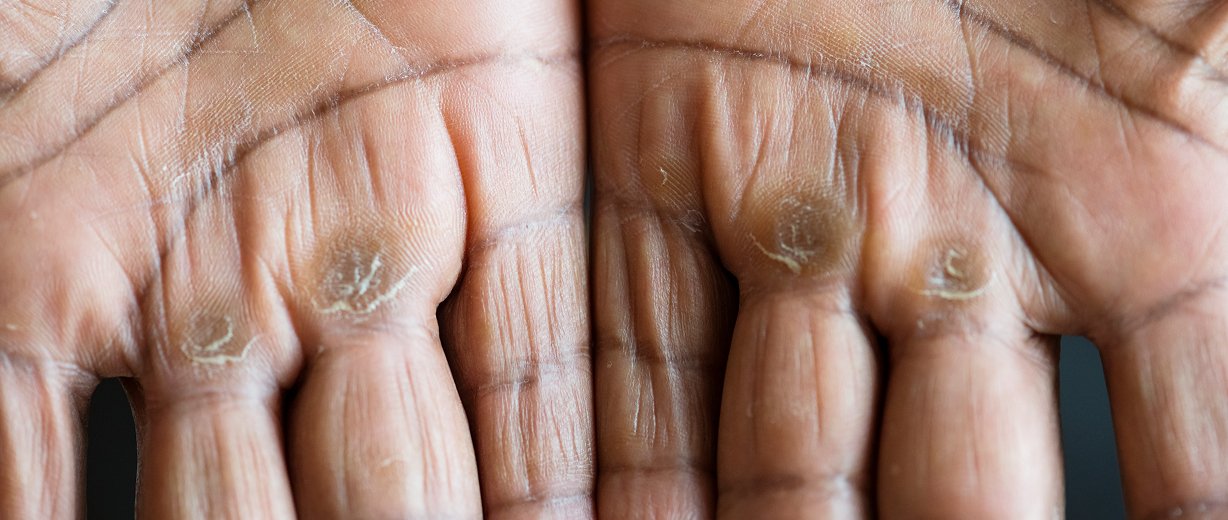 Wart Removal Treatment