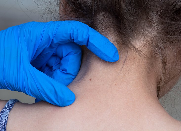 Wart Removal Procedure