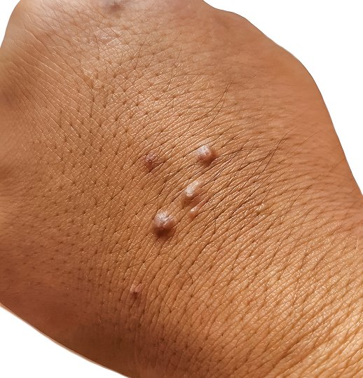 Wart Treatment